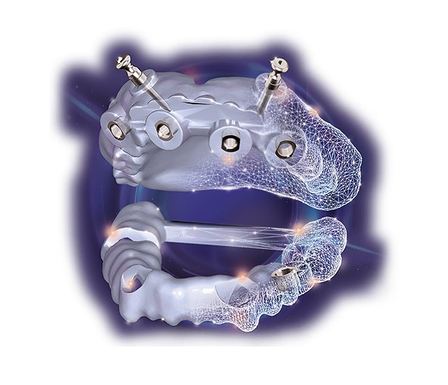 exocad exoplan